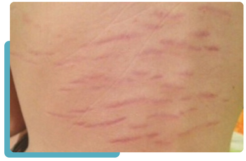 Bartonella Rash