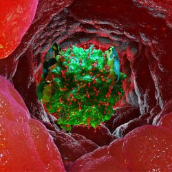Mastocytosis